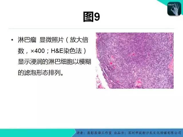 【PPT】成人眼眶肿瘤：临床、影像、与病理回顾