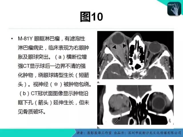 【PPT】成人眼眶肿瘤：临床、影像、与病理回顾
