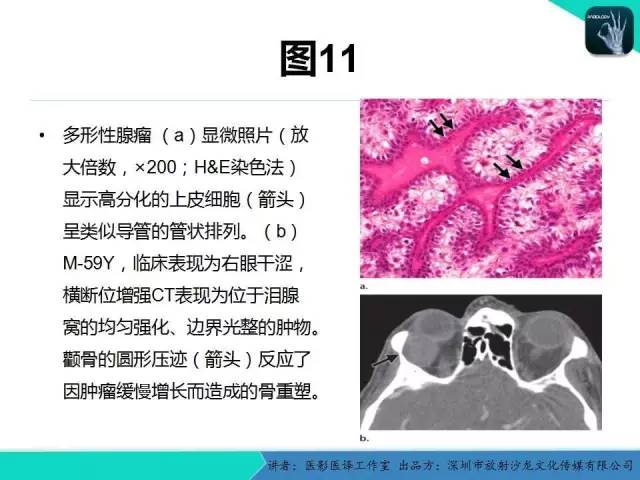 【PPT】成人眼眶肿瘤：临床、影像、与病理回顾