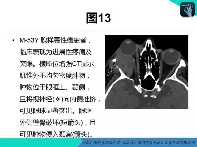 【PPT】成人眼眶肿瘤：临床、影像、与病理回顾