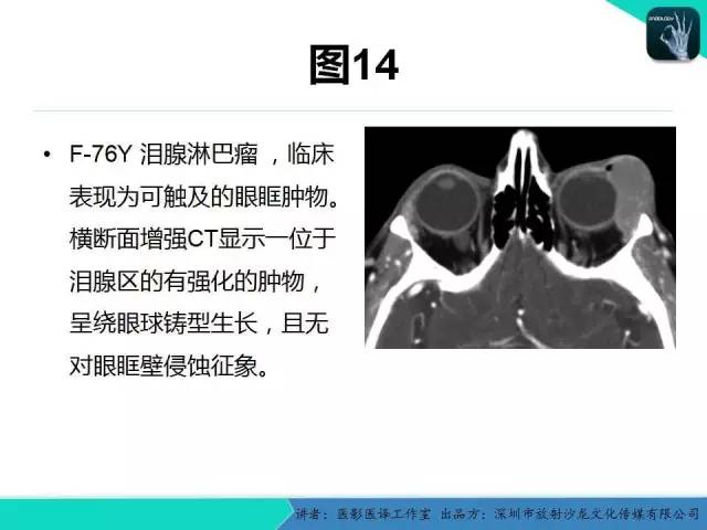 【PPT】成人眼眶肿瘤：临床、影像、与病理回顾