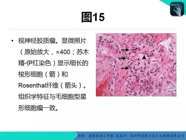 【PPT】成人眼眶肿瘤：临床、影像、与病理回顾
