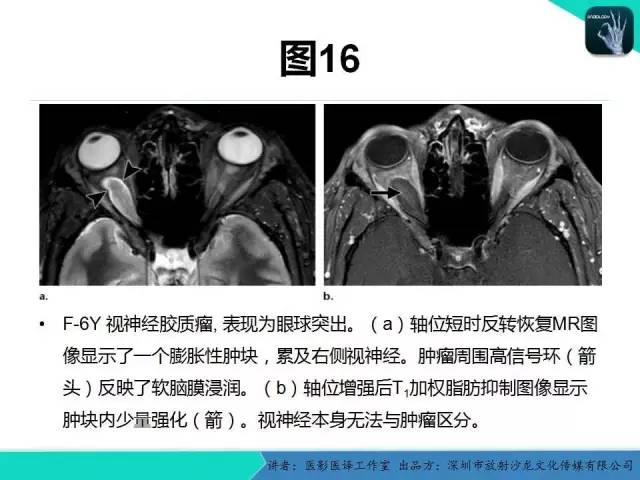 【PPT】成人眼眶肿瘤：临床、影像、与病理回顾