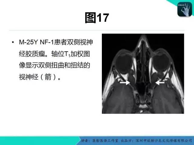【PPT】成人眼眶肿瘤：临床、影像、与病理回顾