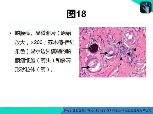 【PPT】成人眼眶肿瘤：临床、影像、与病理回顾