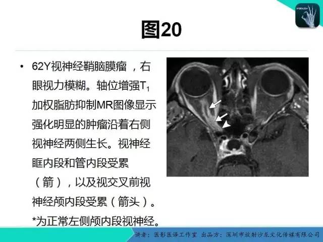【PPT】成人眼眶肿瘤：临床、影像、与病理回顾