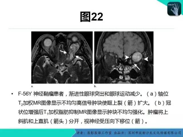 【PPT】成人眼眶肿瘤：临床、影像、与病理回顾