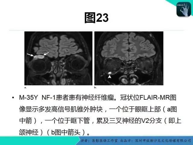 【PPT】成人眼眶肿瘤：临床、影像、与病理回顾
