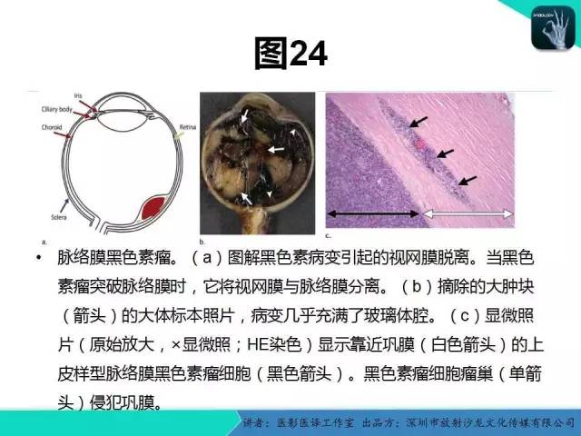 【PPT】成人眼眶肿瘤：临床、影像、与病理回顾