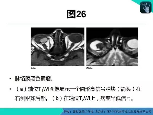 【PPT】成人眼眶肿瘤：临床、影像、与病理回顾