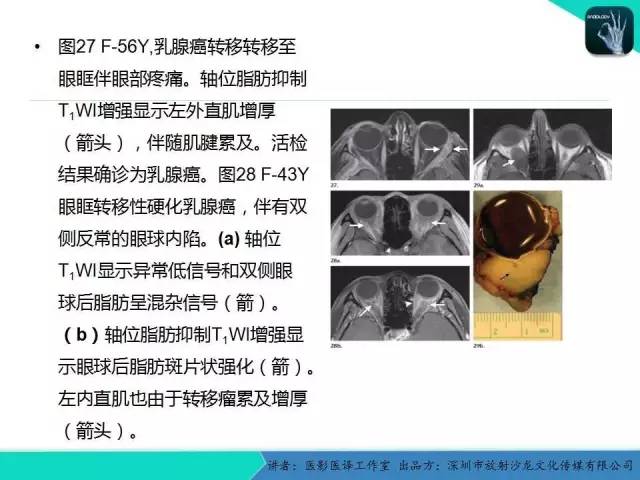 【PPT】成人眼眶肿瘤：临床、影像、与病理回顾
