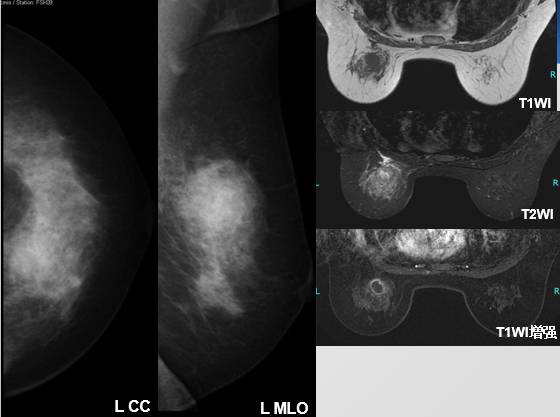 乳腺X线征象:良恶性肿块判读 乳腺X线征象:良恶性肿块判读