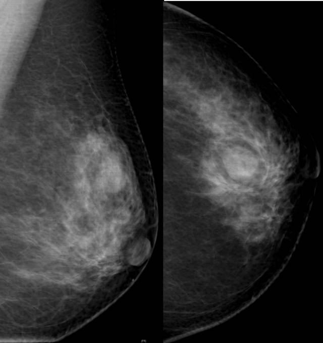 乳腺X线征象:良恶性肿块判读 乳腺X线征象:良恶性肿块判读