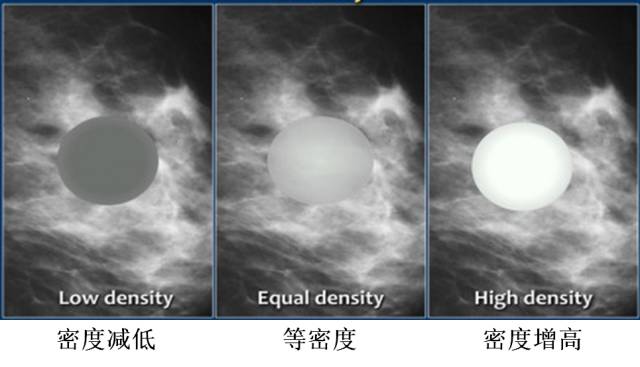 乳腺X线征象:良恶性肿块判读 乳腺X线征象:良恶性肿块判读