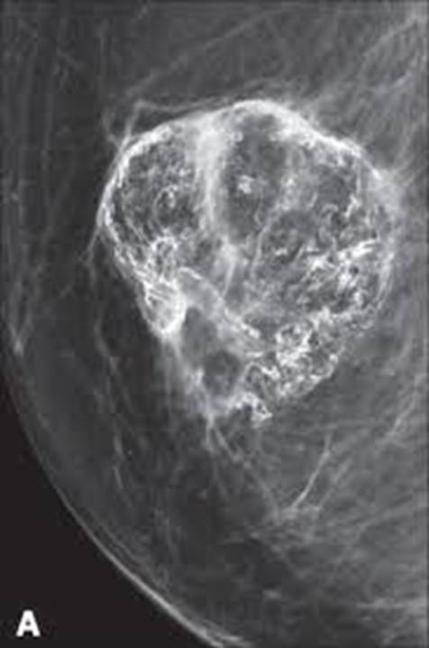 乳腺X线征象:良恶性肿块判读 乳腺X线征象:良恶性肿块判读