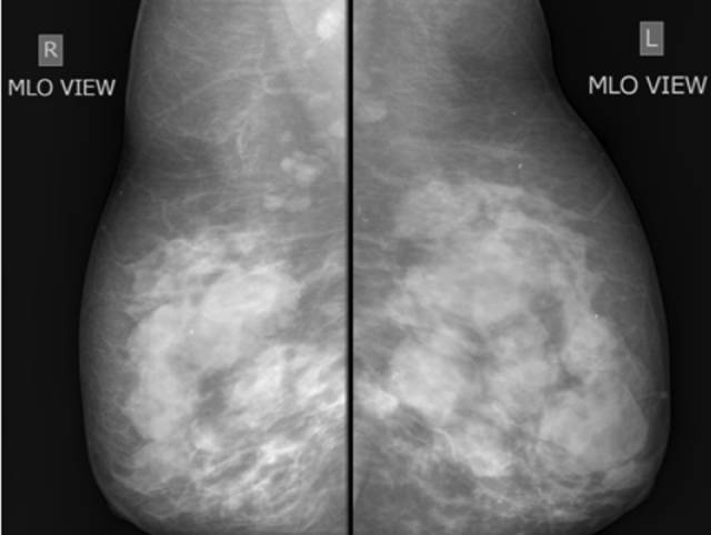 乳腺X线征象:良恶性肿块判读 乳腺X线征象:良恶性肿块判读