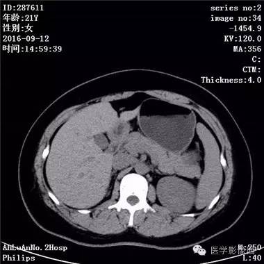 【病例】胰腺实性假乳头状瘤1例CT影像表现 【病例】胰腺实性假乳头状瘤1例CT影像表现