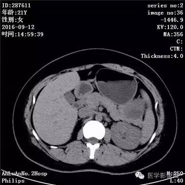 【病例】胰腺实性假乳头状瘤1例CT影像表现 【病例】胰腺实性假乳头状瘤1例CT影像表现