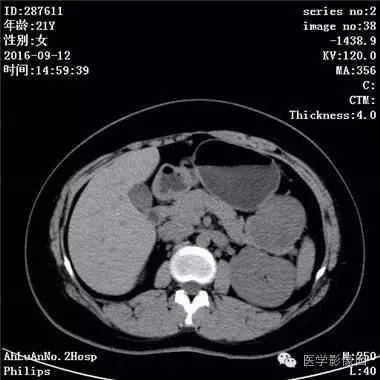 【病例】胰腺实性假乳头状瘤1例CT影像表现 【病例】胰腺实性假乳头状瘤1例CT影像表现