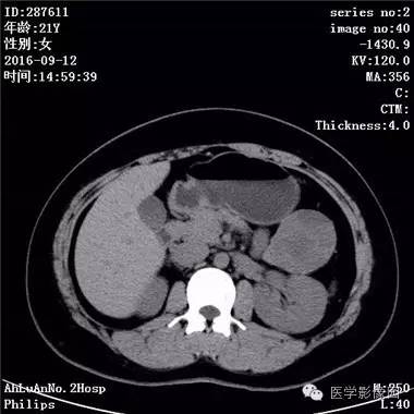 【病例】胰腺实性假乳头状瘤1例CT影像表现 【病例】胰腺实性假乳头状瘤1例CT影像表现