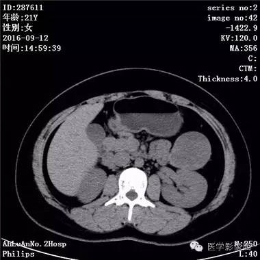 【病例】胰腺实性假乳头状瘤1例CT影像表现