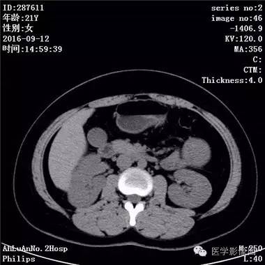 【病例】胰腺实性假乳头状瘤1例CT影像表现 【病例】胰腺实性假乳头状瘤1例CT影像表现