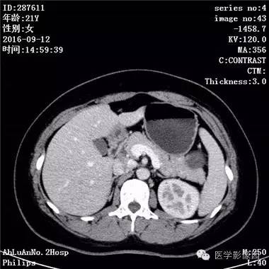 【病例】胰腺实性假乳头状瘤1例CT影像表现 【病例】胰腺实性假乳头状瘤1例CT影像表现