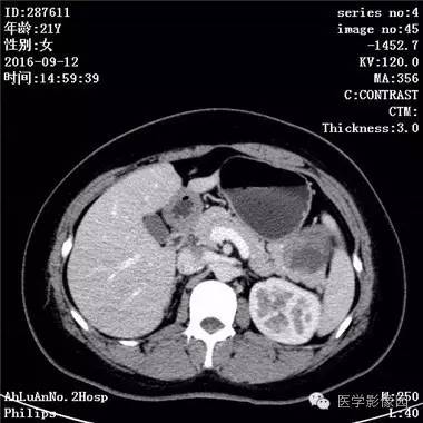 【病例】胰腺实性假乳头状瘤1例CT影像表现 【病例】胰腺实性假乳头状瘤1例CT影像表现