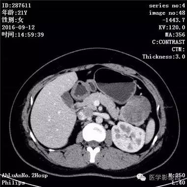 【病例】胰腺实性假乳头状瘤1例CT影像表现 【病例】胰腺实性假乳头状瘤1例CT影像表现