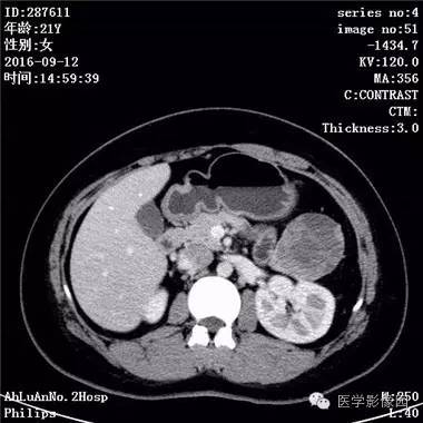 【病例】胰腺实性假乳头状瘤1例CT影像表现 【病例】胰腺实性假乳头状瘤1例CT影像表现