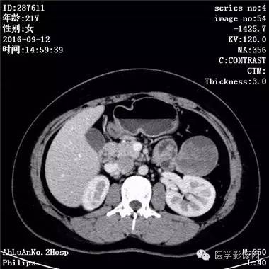 【病例】胰腺实性假乳头状瘤1例CT影像表现 【病例】胰腺实性假乳头状瘤1例CT影像表现