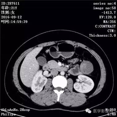 【病例】胰腺实性假乳头状瘤1例CT影像表现 【病例】胰腺实性假乳头状瘤1例CT影像表现