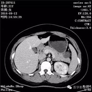 【病例】胰腺实性假乳头状瘤1例CT影像表现 【病例】胰腺实性假乳头状瘤1例CT影像表现