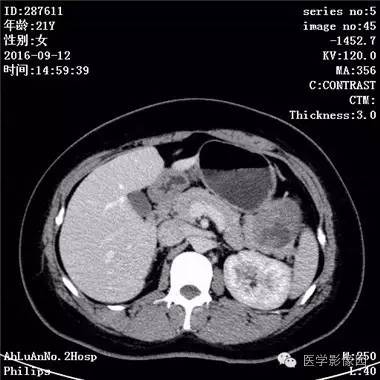 【病例】胰腺实性假乳头状瘤1例CT影像表现 【病例】胰腺实性假乳头状瘤1例CT影像表现