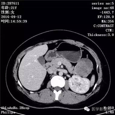 【病例】胰腺实性假乳头状瘤1例CT影像表现 【病例】胰腺实性假乳头状瘤1例CT影像表现