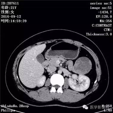 【病例】胰腺实性假乳头状瘤1例CT影像表现 【病例】胰腺实性假乳头状瘤1例CT影像表现