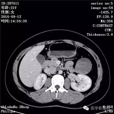【病例】胰腺实性假乳头状瘤1例CT影像表现 【病例】胰腺实性假乳头状瘤1例CT影像表现