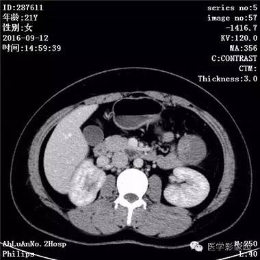 【病例】胰腺实性假乳头状瘤1例CT影像表现 【病例】胰腺实性假乳头状瘤1例CT影像表现