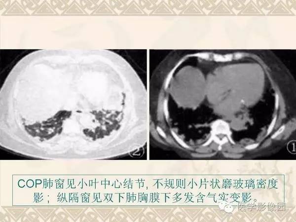 【PPT】隐源性机化性肺炎