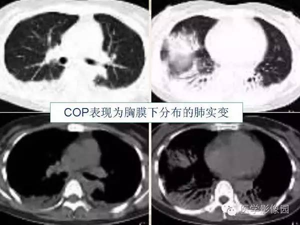 【PPT】隐源性机化性肺炎