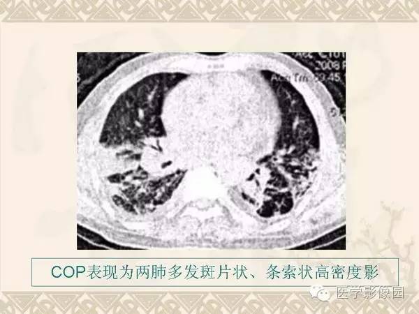 【PPT】隐源性机化性肺炎