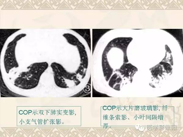 【PPT】隐源性机化性肺炎