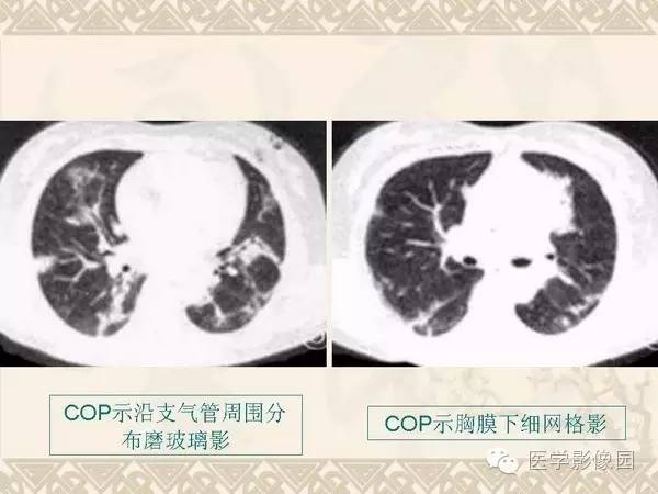 【PPT】隐源性机化性肺炎