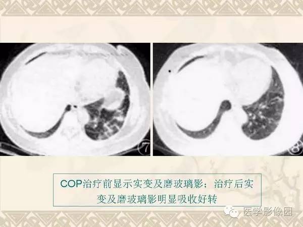 【PPT】隐源性机化性肺炎