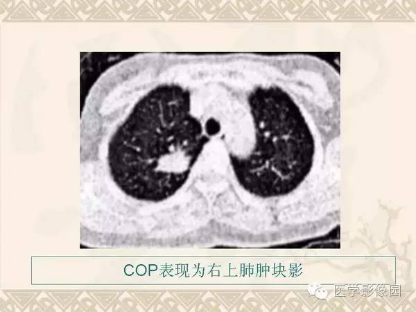 【PPT】隐源性机化性肺炎