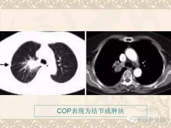 【PPT】隐源性机化性肺炎