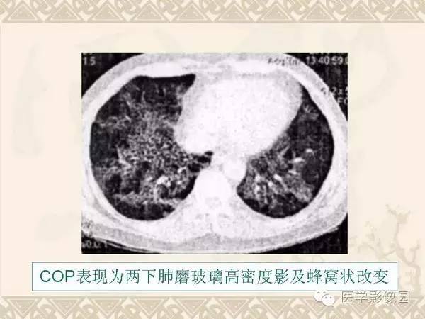 【PPT】隐源性机化性肺炎