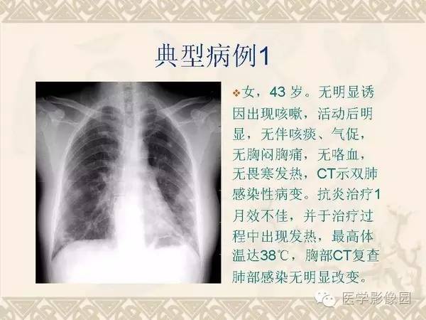 【PPT】隐源性机化性肺炎
