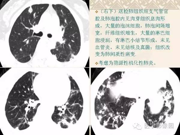 【PPT】隐源性机化性肺炎