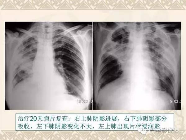 【PPT】隐源性机化性肺炎
